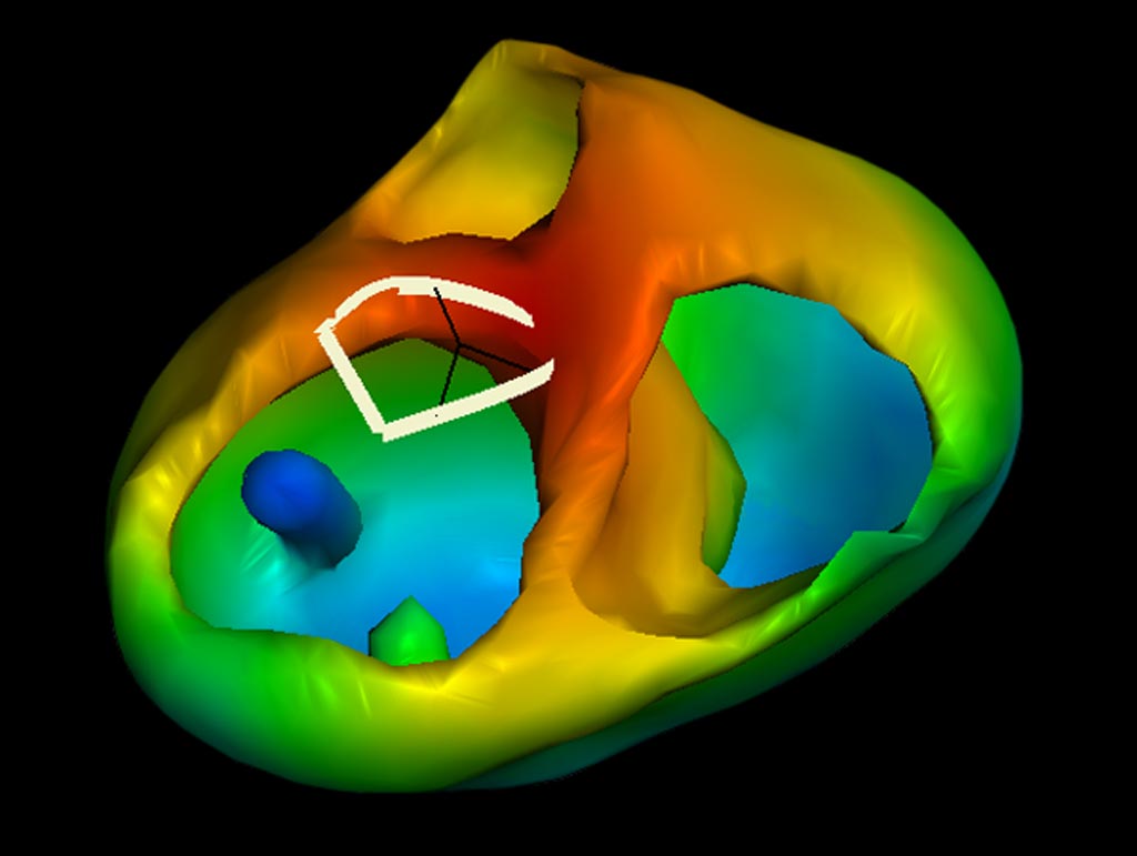 Image: A three-dimensional cardiac model generated from a photograph, ECG selection, and imaging scan (Photo courtesy of Catheter Precision).