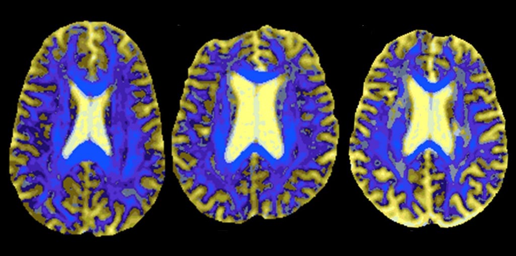Image: DSEG images of the reference brain (L), a stable SVD patient (C), and a patient who developed dementia (R) (Photo courtesy of Rebecca Charlton/ Goldsmith University of London).