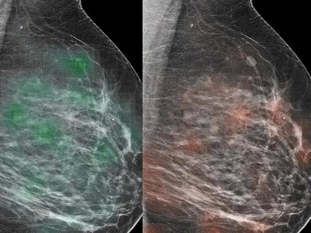 Image: An AI tool-radiologist combo can identify breast cancer with approximately 90% accuracy (Photo courtesy of MDN).