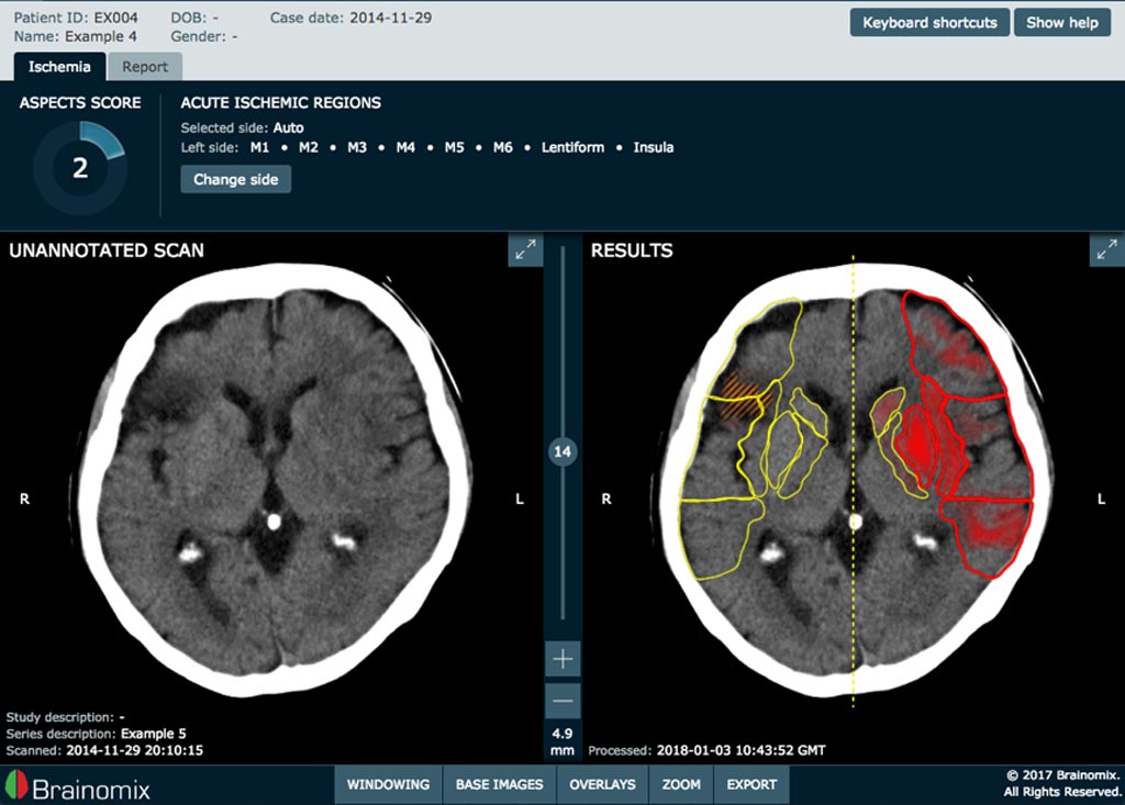 Image: The e-ASPECTS software uses AI algorithms to automatically identify and quantify acute ischemic core within seconds of the scan acquisition (Photo courtesy of Brainomix).