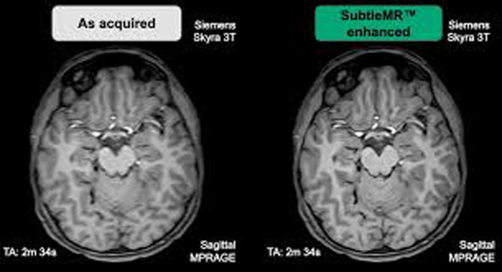 Image: The SubtleMR software is designed to deliver a significant improvement in the quality of noisy images (Photo courtesy of Subtle Medical).