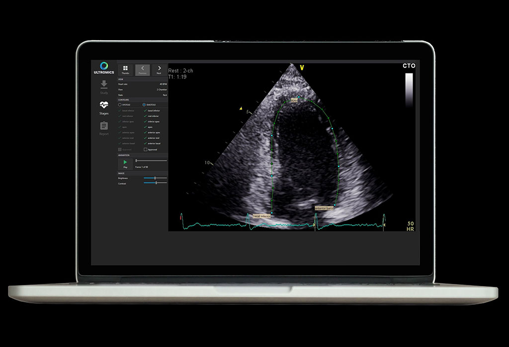 Image: Auto contouring generated by EchoGo, calculating key cardiac parameters (Photo courtesy of Ultromics)