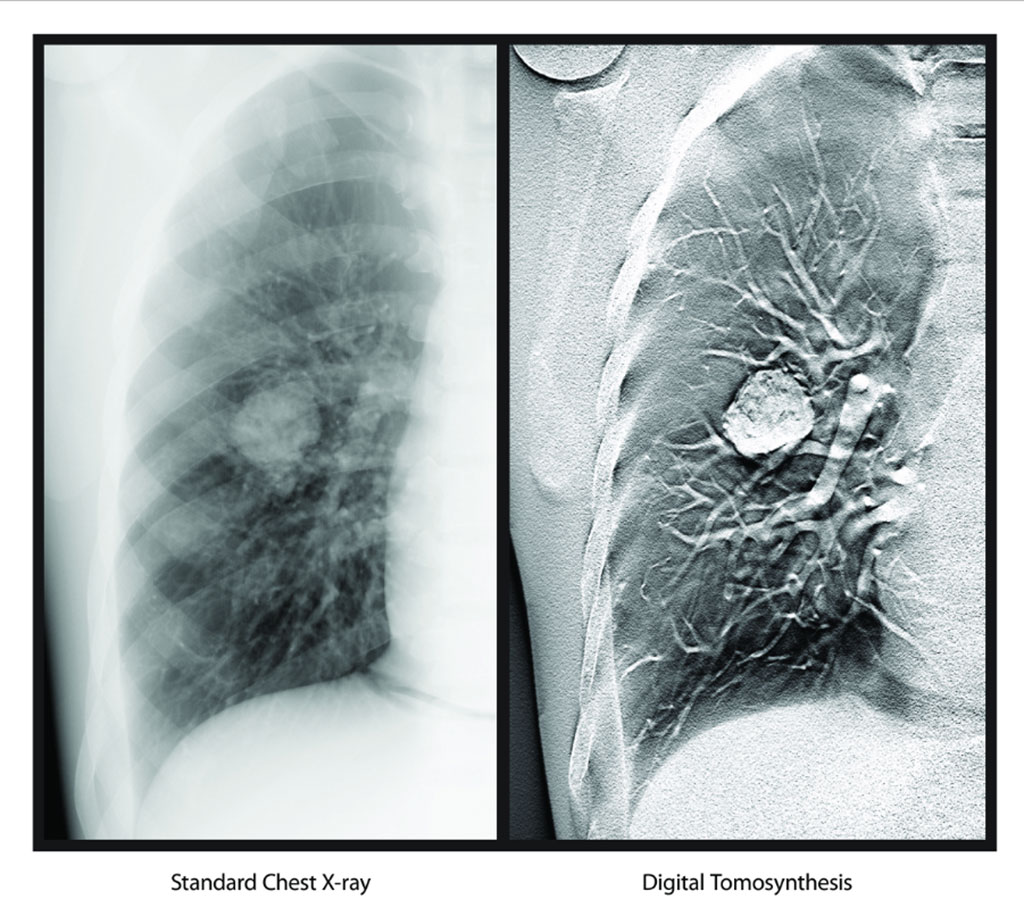 Image: Digital Tomosynthesis (Photo courtesy of Carestream Health)