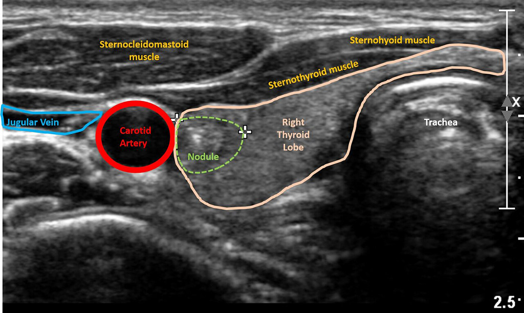 Image: Ultrasound image of thyroid nodule (Photo courtesy of Sidney Kimmel Cancer Center -- Jefferson Health)