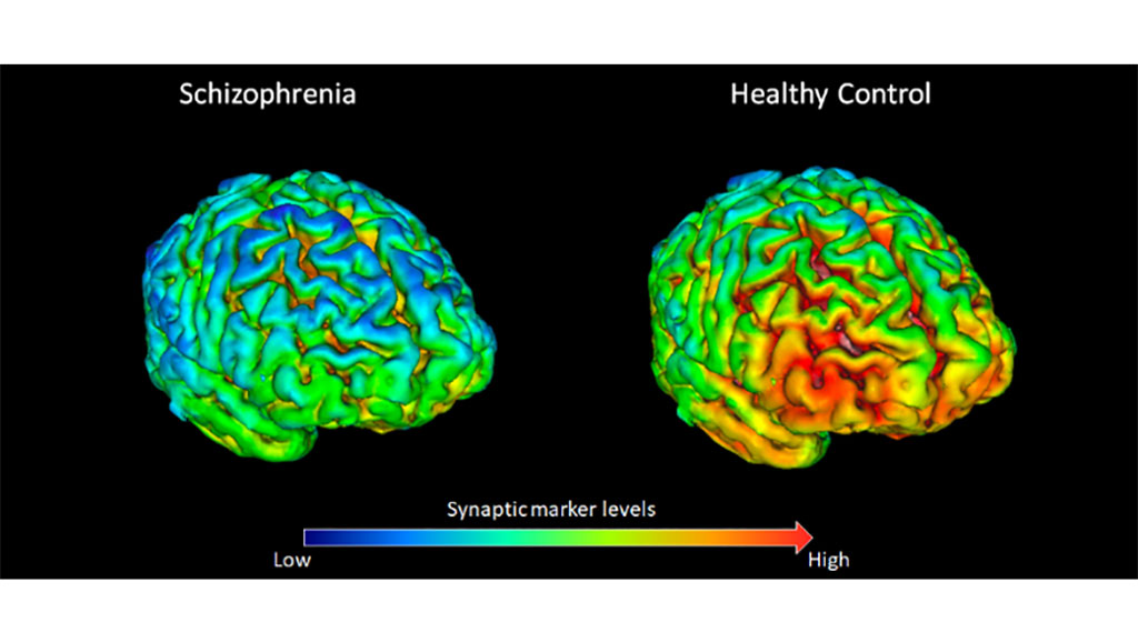 Image: Protein deficiency in neural synapses could explain schizophrenia (Photo courtesy of KCL)