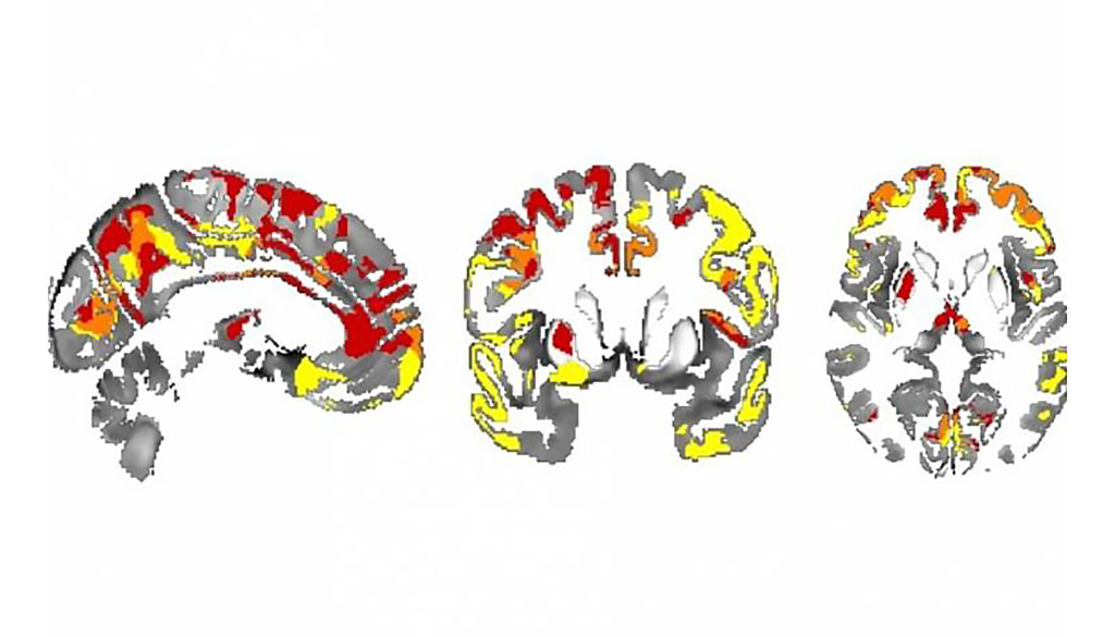 Image: Iron depositions in the brain can track Parkinson’s evolvement (Photo courtesy of UCL)