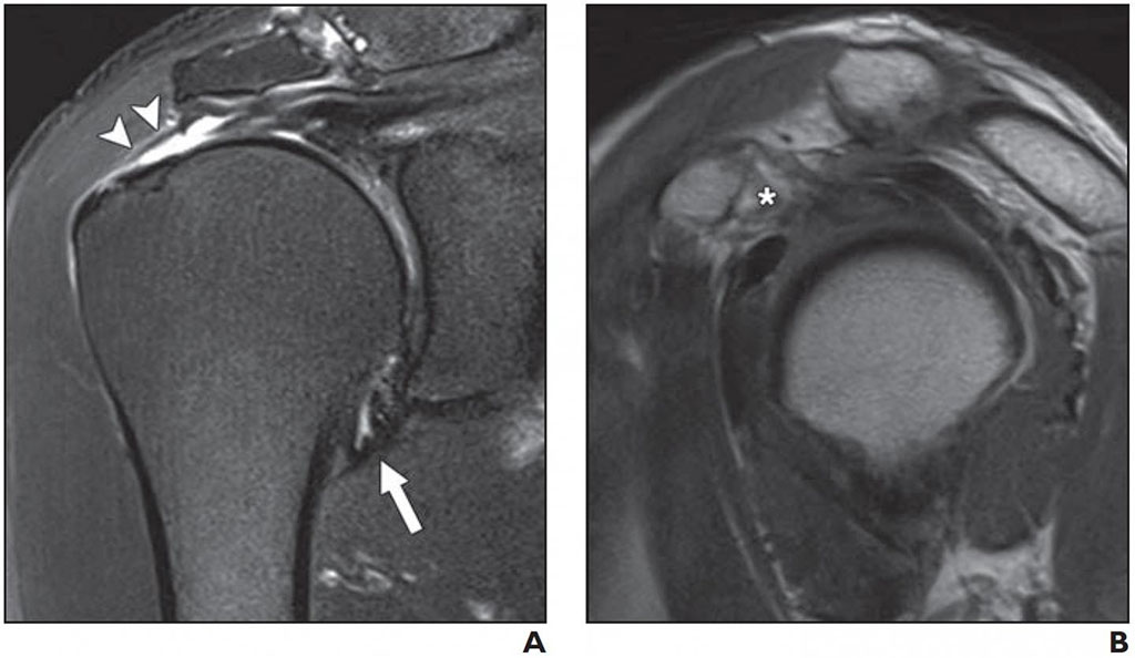 Image: Normal joint capsule at axillary recess (A); Full-thickness tear of supraspinatus tendon (B) (Photo courtesy AJR)