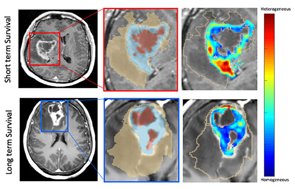 Image: MRI scans showing radiomic prognostic features (Photo curtesy of CWRU)