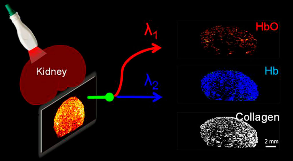 Image: Photoacoustic imaging can reveal collagen distribution in a donor kidney (Photo courtesy of JCI Insight)