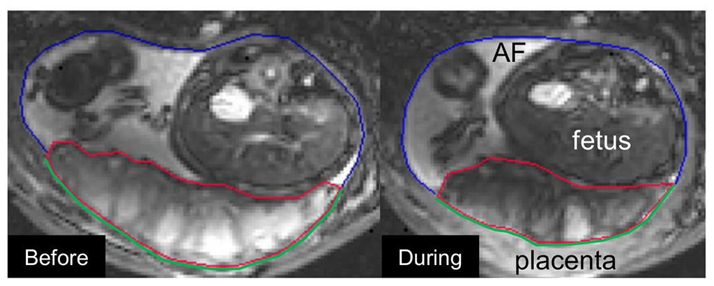 Image: Example of the utero-placental pump; relaxed placenta (L), contracted placenta (R) (Photo courtesy Nelle Dellschaft/ University of Nottingham)