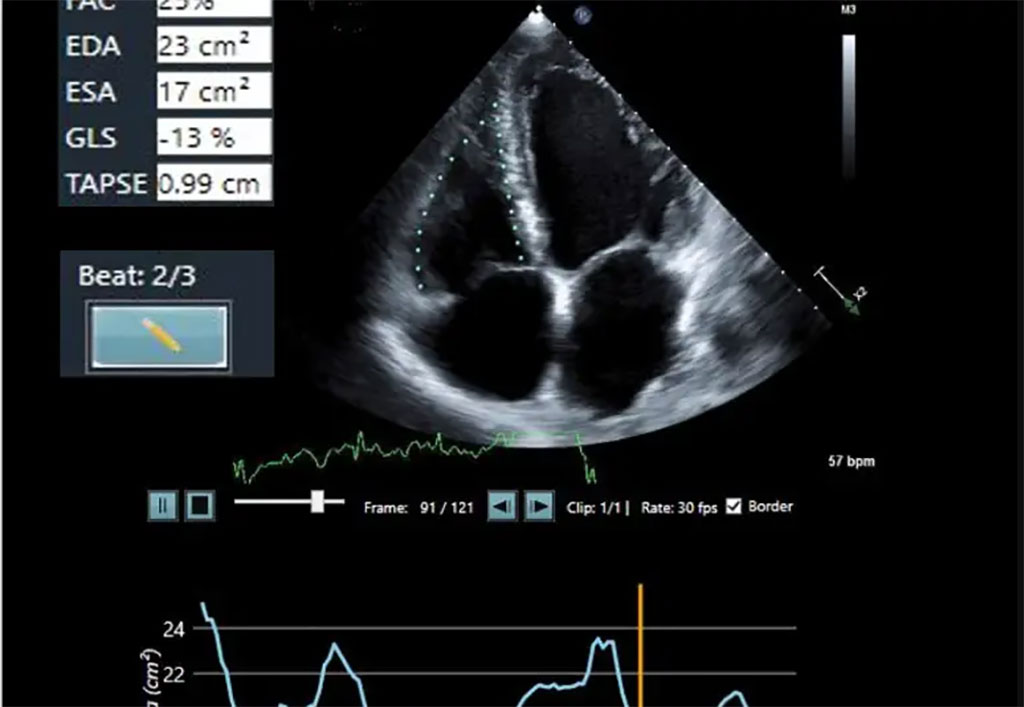 Image: LVivo RV uses AI to immediately detect signs of RV dysfunction (Photo courtesy of DiA Imaging Analysis)