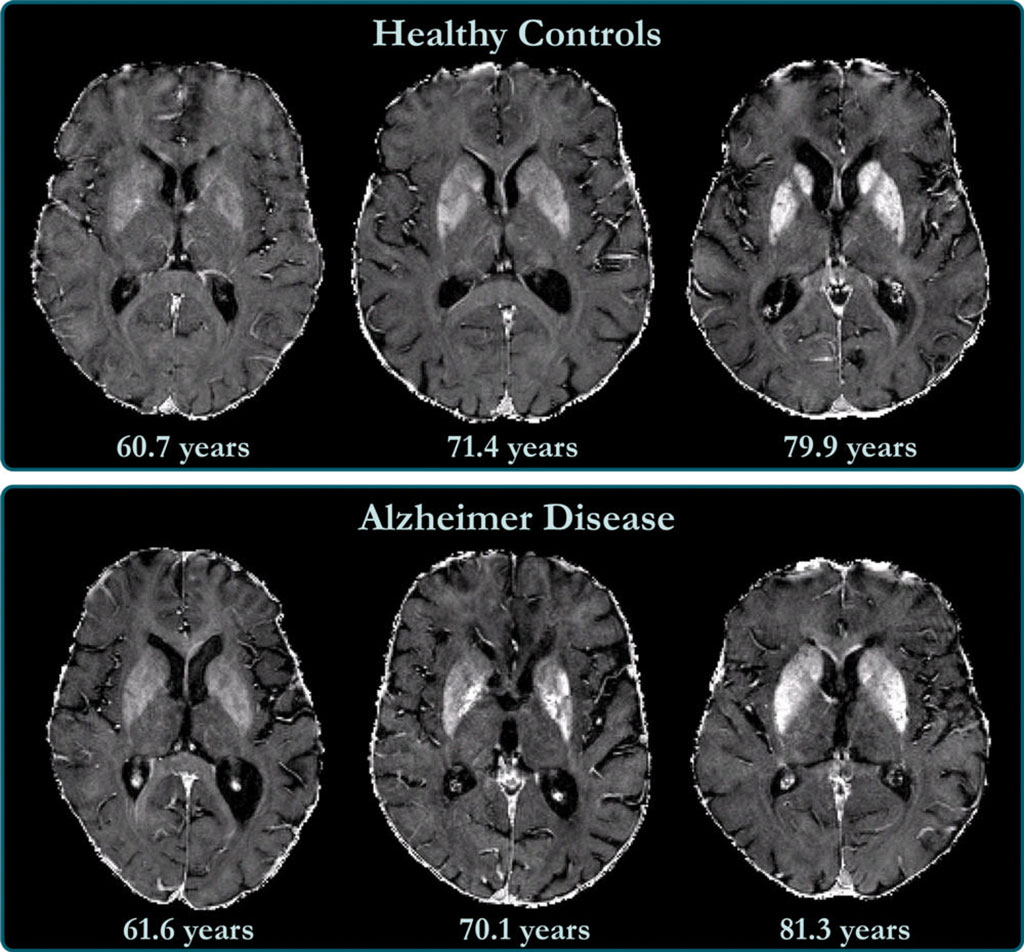 Image: R2* maps of healthy control participants and participants with AD (Photo courtesy of RSNA)