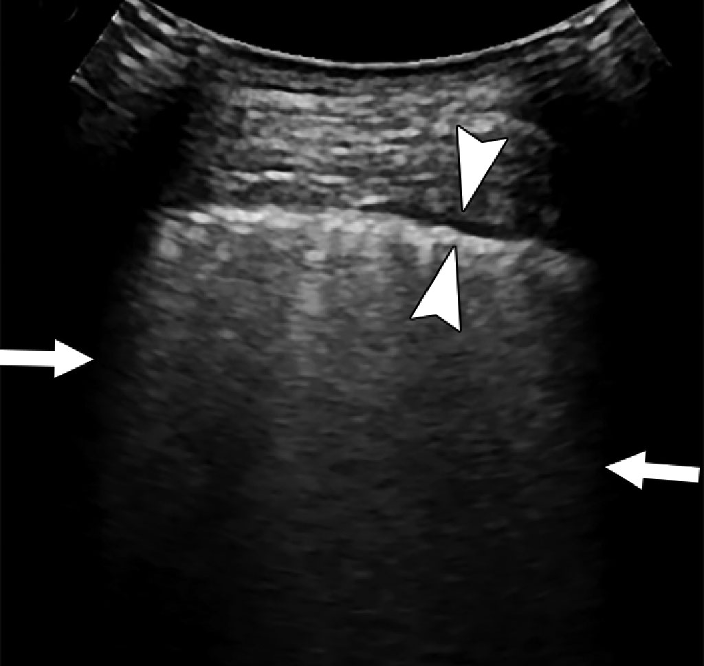 Image: Multiple confluent B-lines (arrows), and thickened pleural line (arrowheads) in an 82 year old COVID-19 patient (Photo courtesy of AJR)