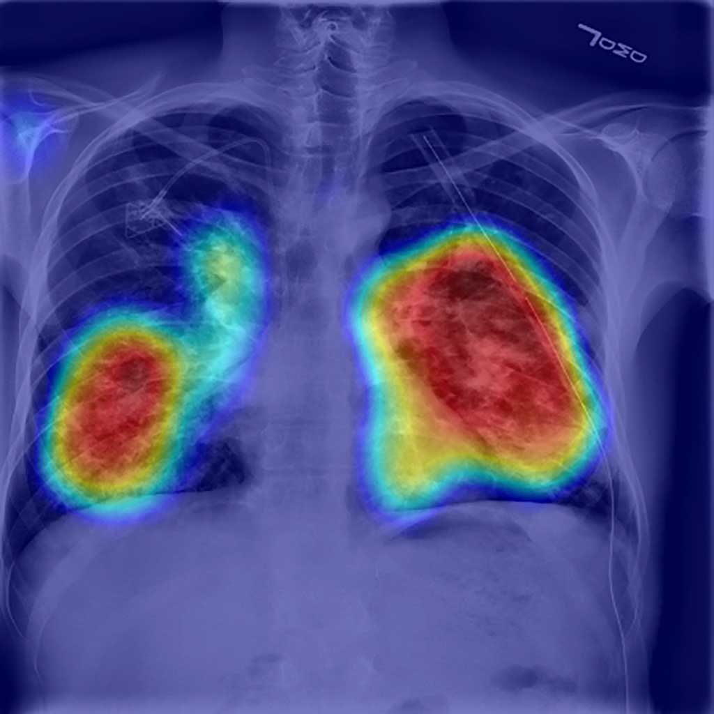 Image: Possible pneumothorax areas identified by AI (Photo courtesy of RADLogics)