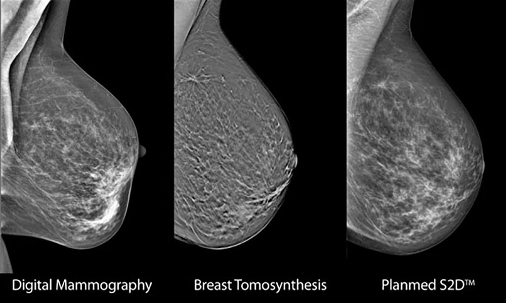 Image: Comparsion between DM, DBT, and SM (Photo courtesy of Planmed)