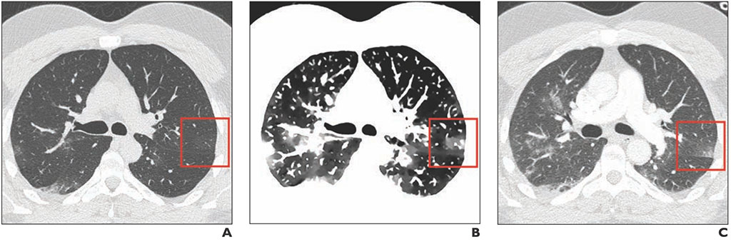 Image: Initial conventional axial CT image (A), Spectral ED image clearly showing GGO lesions, and conventional axial CT image two days after images A and B (C). (Photo courtesy of AJR)