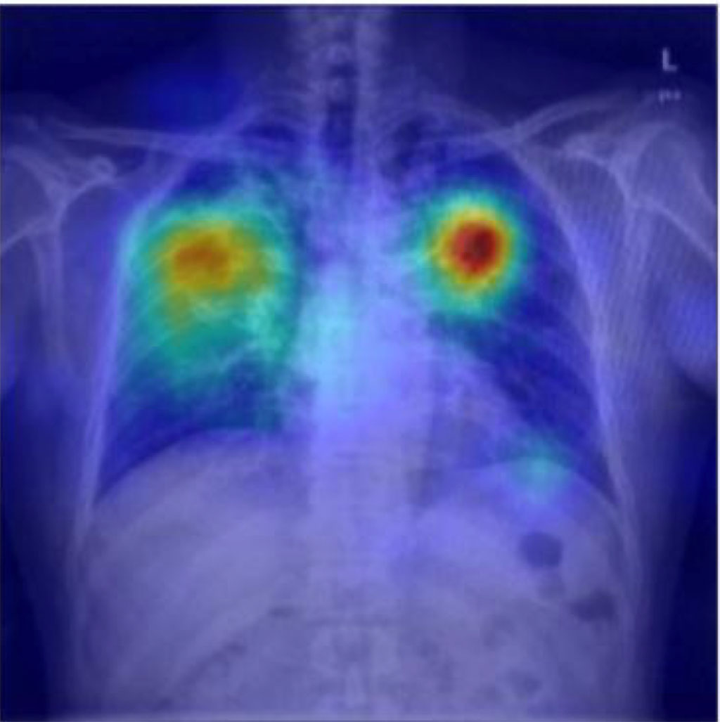 Image: TB can be detected via smartphone photos in resource poor settings (Photo courtesy of RSNA)