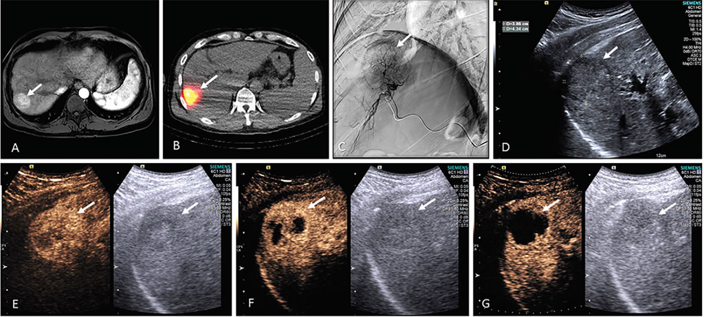 Image: Images from a 54-year-old male patient with HCC who underwent TARE with UTMD. The bottom row shows B-mode ultrasound of tumor destruction at different time points after the procedure (Photo courtesy of TJU)