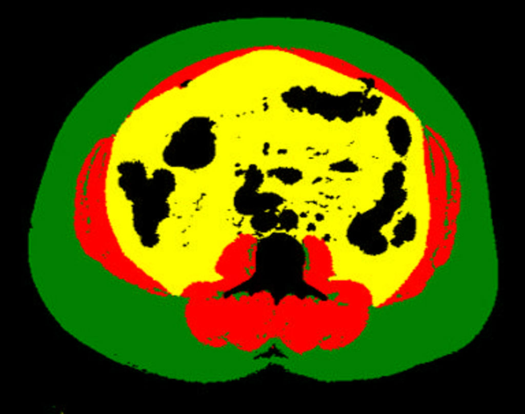 Image: Example of body composition analysis of an abdominal CT slice with subcutaneous fat in green, skeletal muscle in red, and visceral fat in yellow (Photo courtesy of UCSF)