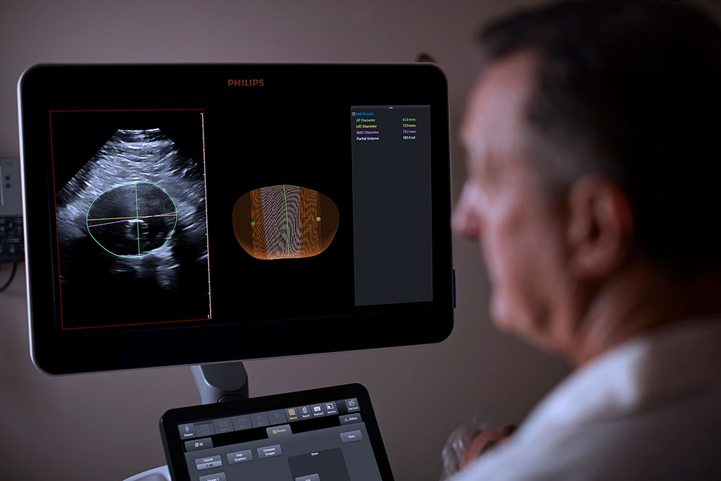 Image: A new ultrasound model helps monitor AAA progression (Photo courtesy of Philips)