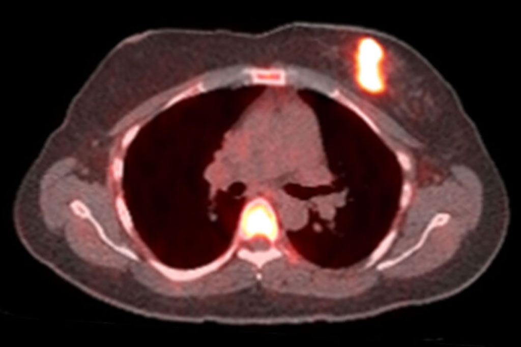 Image: Bright spots on PET indicate cancer cells responding to a one-day estrogen challenge (Photo courtesy of Farrokh Dehdashti/ WUSTL)