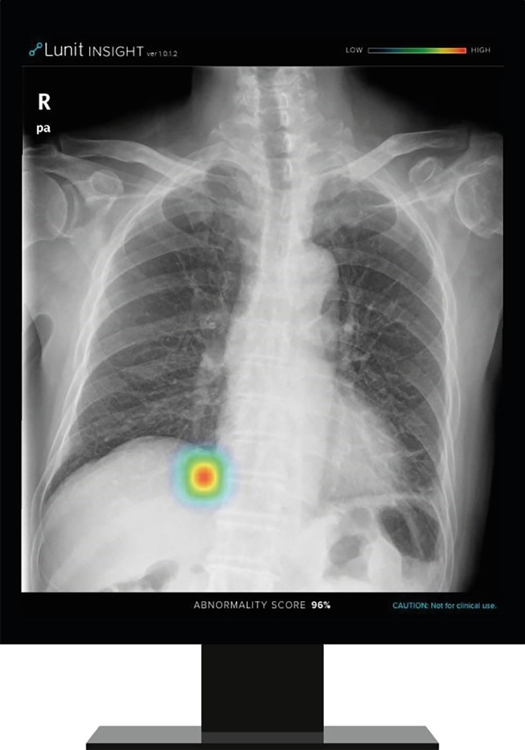 Image: Insight CXR detects abnormalities on a chest X-ray image (Photo courtesy of Lunit)