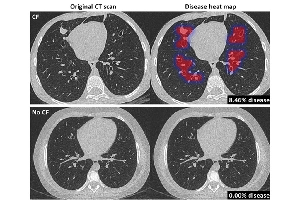 Image: Original CT scan (L) and Pragma-AI overlay heat map (R) in the lungs of a CF patient and healthy control (Photo courtesy of Thirona)