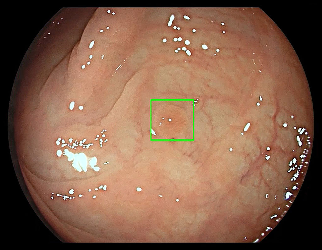 Image: The GI Genius automatically identifies and marks (with a green box) colorectal polyps (Photo courtesy of Medtronic)