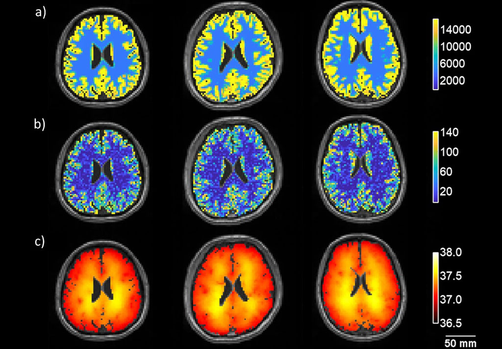 Image: Metabolic heat (a), cerebral blood flow (b) and model-predicted brain temperature (c) in three volunteers (Photo courtesy of Emory University)