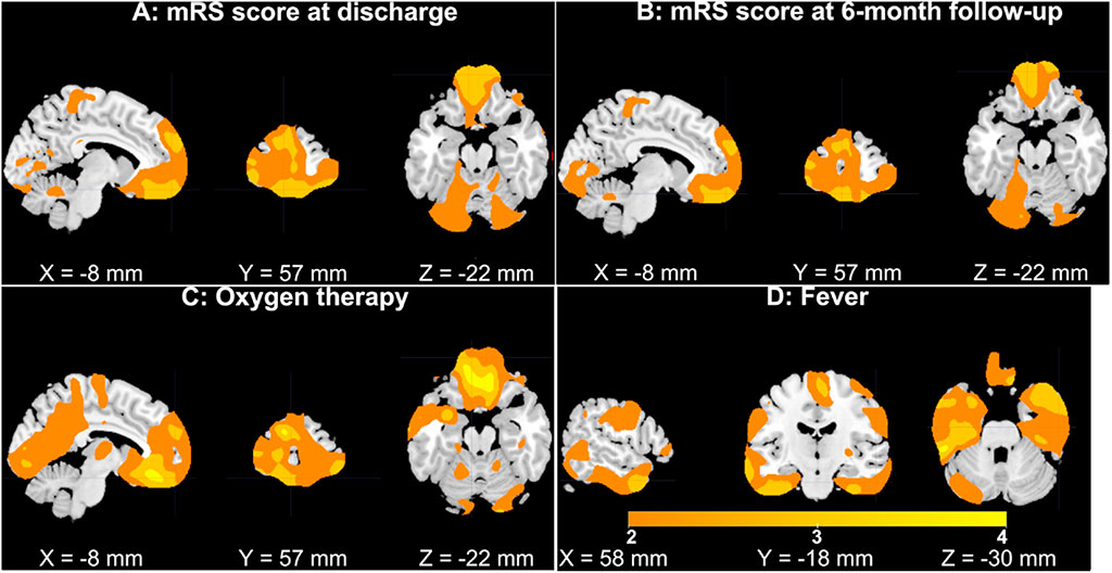 Image: Subplots of GMV in superior/medial/middle frontal gyri (Photo courtesy of Georgia Institute of Technology)