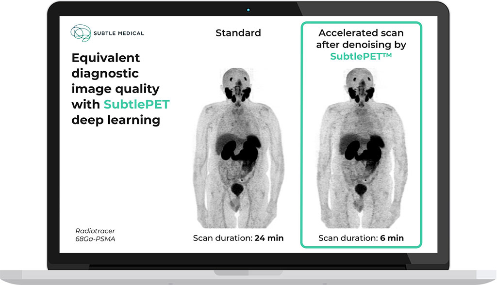 Image: Equivalent diagnostic image quality of SubtlePET software (Photo courtesy of Subtle Medical)