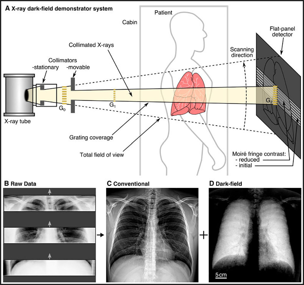 Image: Schematic of the prototype dark-field X-ray system (Photo courtesy of Radiology)
