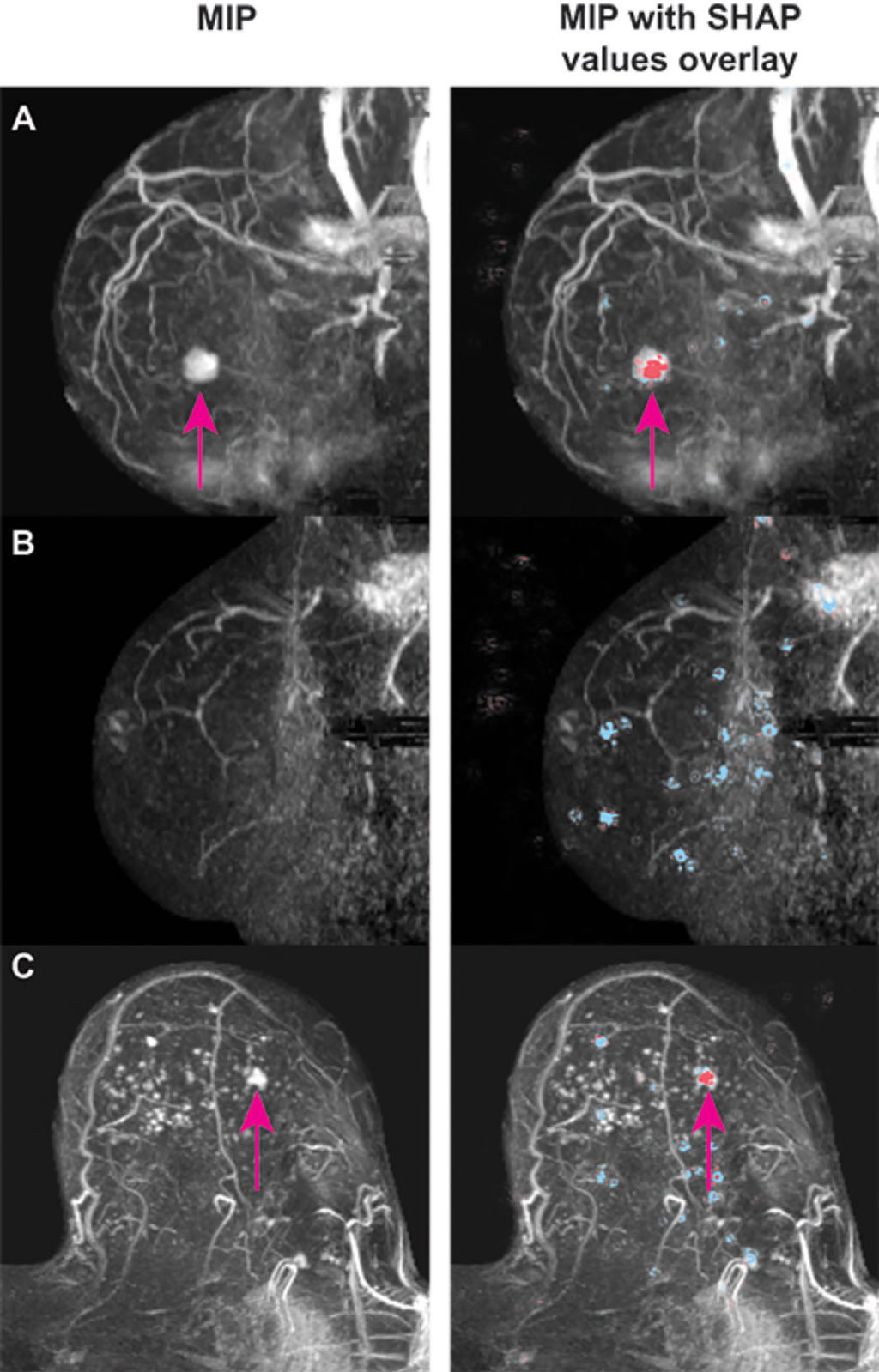 a) Conceptual patient set up under MRI scanner. (b) Average breast size.