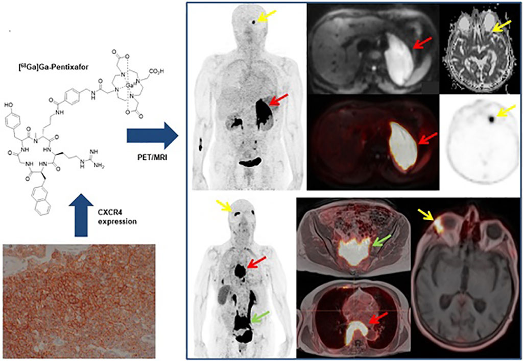 Image: MALT lymphomas express the chemokine receptor CXCR4 (Photo courtesy of MedUni)