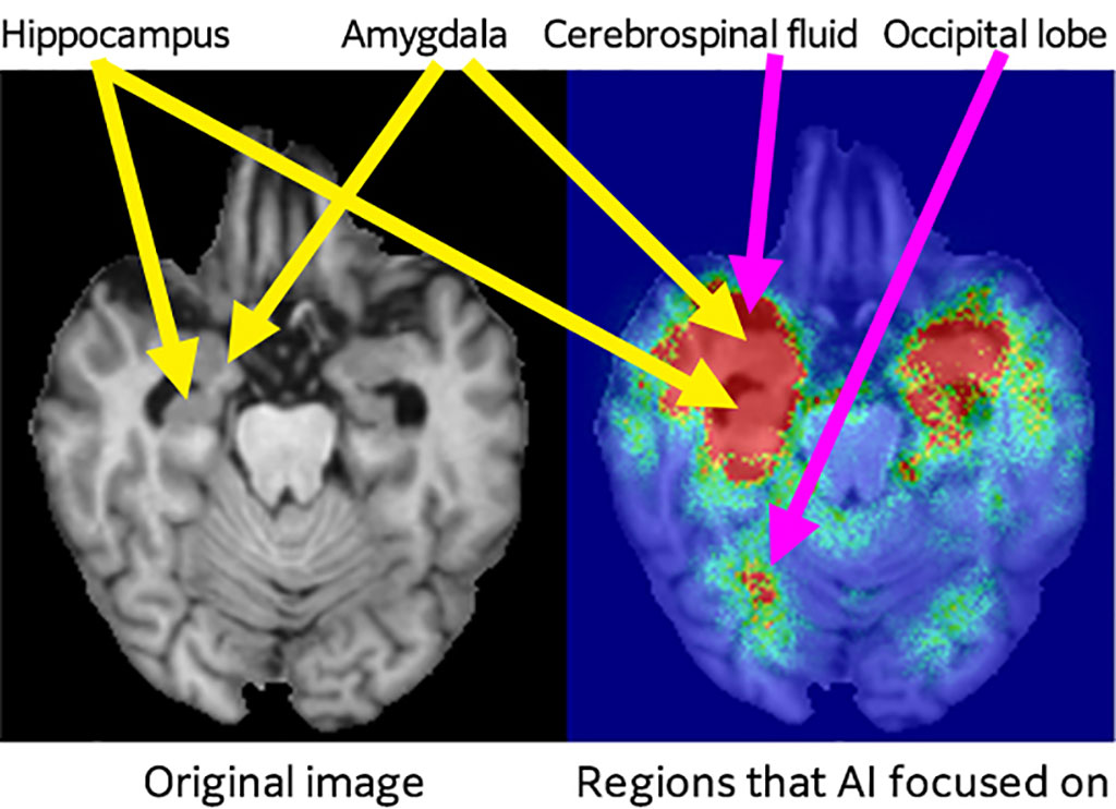 Image: 3D MRI images showing atrophy patterns that AI focused on to predict AD progression (Photo courtesy of FUJIFILM)