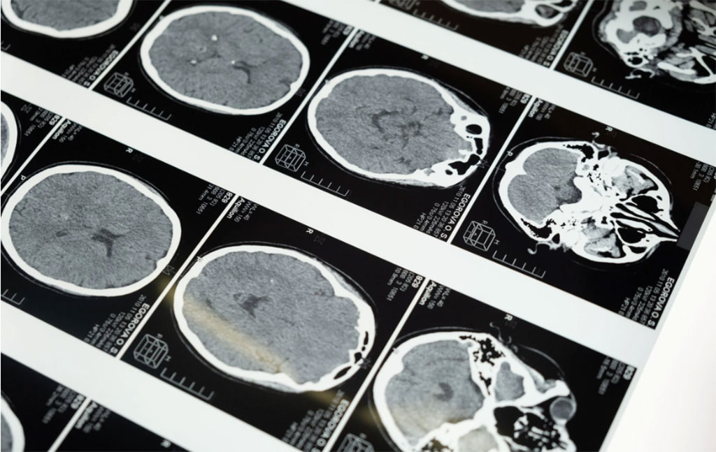 Image: MRI identifies markers of atypical brain development in children born preterm (Photo courtesy of Pexels)