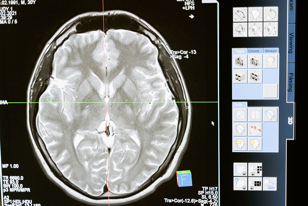 Image: Brain inflammation commonly accompanies Alzheimer’s disease (Photo courtesy of Pexels)