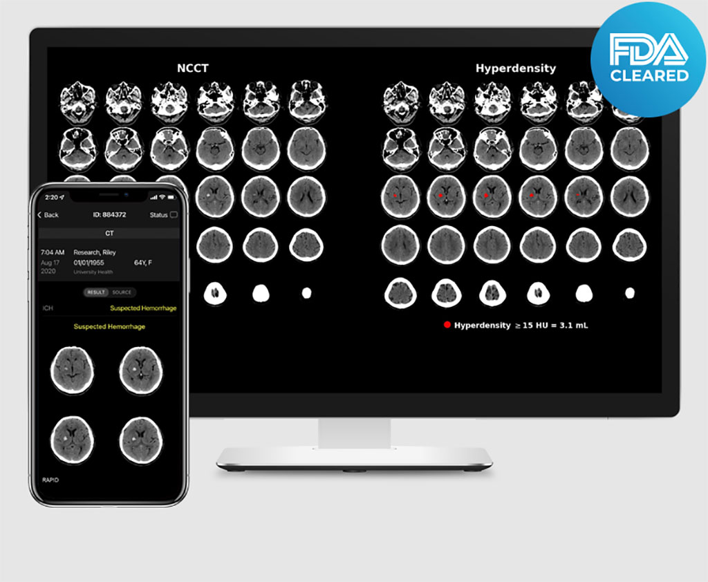 Image: Rapid ICH had received new FDA clearance with highest sensitivity and specificity on the market (Photo courtesy of RapidAI)