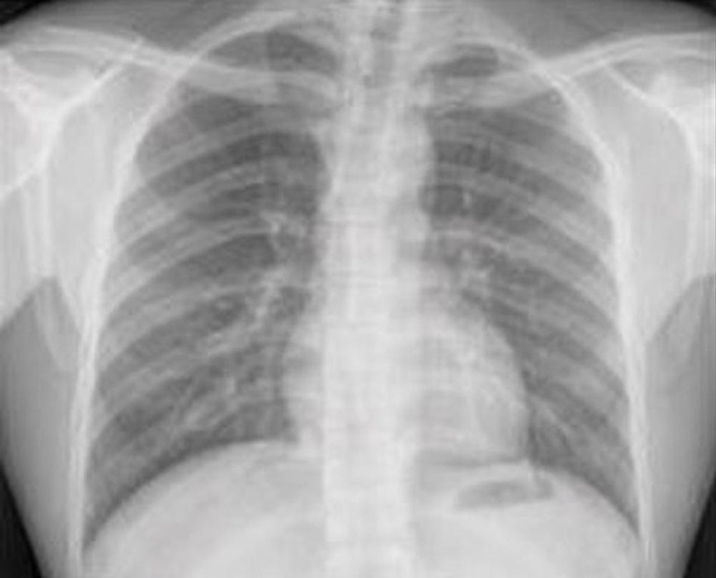 Image: Deep learning model screens for CVD risk using chest X-ray images (Photo courtesy of Massachusetts General Hospital)
