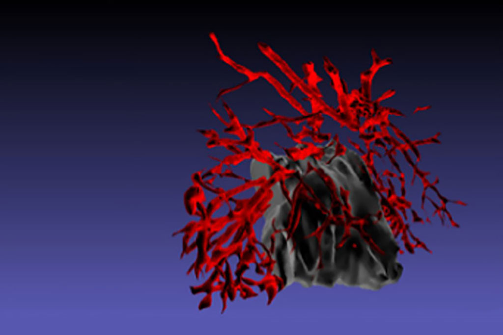 Image: New AI-based biomarker can help predict immunotherapy response for patients with lung cancer (Photo courtesy of Emory University)