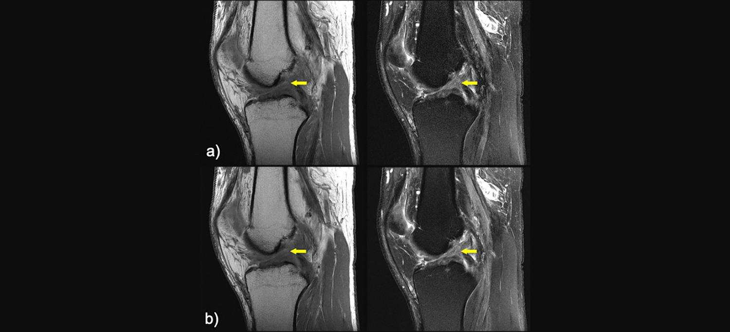 AI reconstructs missing data from rapid MRI scans (Photo courtesy of NYU Langone)