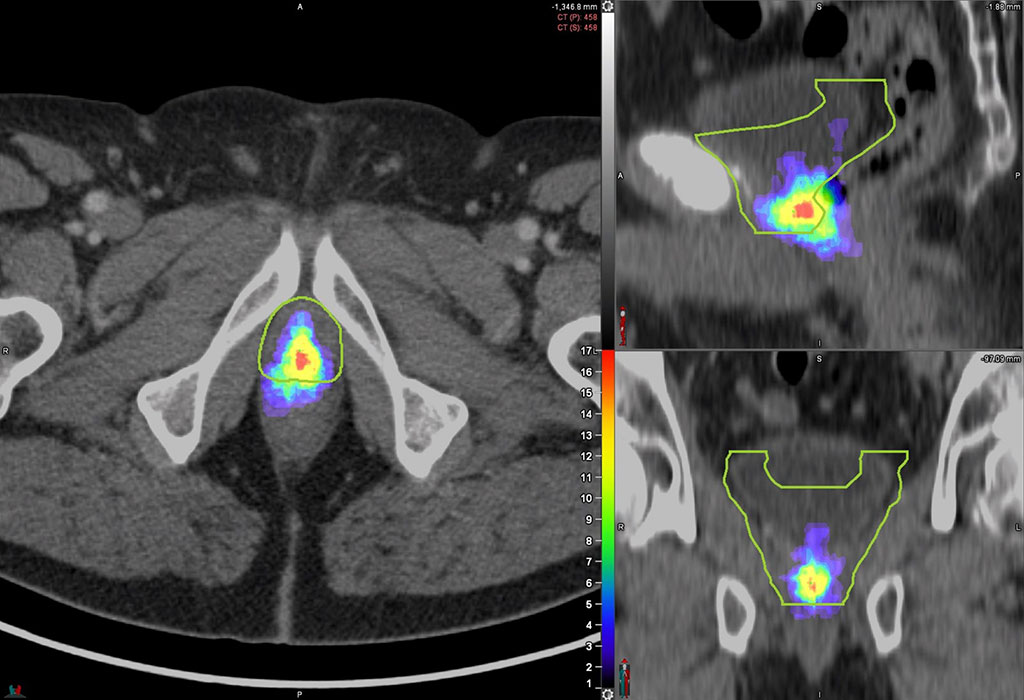 Image: Heat map of prostate bed PSMA PET recurrences (Photo courtesy of UMiami Health System)