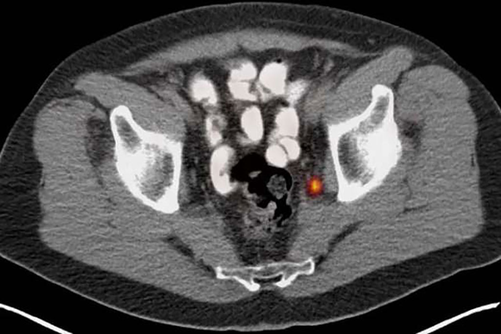 Image: PSMA PET image (Photo courtesy of UCLA)