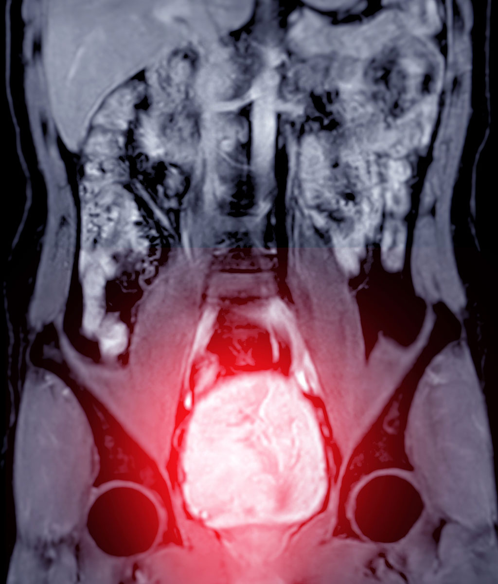 Image: MRI can help diagnose and evaluate extent of prostate cancer before starting radiation therapy (Photo courtesy of 123RF)