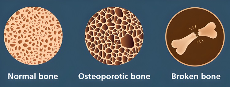 Image: Preventing fractures through bone health (Photo courtesy of BDI)