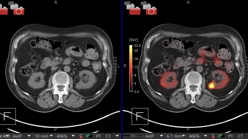 Image: A kidney showing positive [89Zr]Zr-girentuximab PET and histologically confirmed clear-cell renal cell carcinoma (Photo courtesy of Dr. Brian Shuch/UCLA Health)