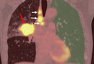 Image: Example of AI analysis of PET/CT images (Photo courtesy of Academic Radiology; DOI: 10.1016/j.acra.2024.08.043)