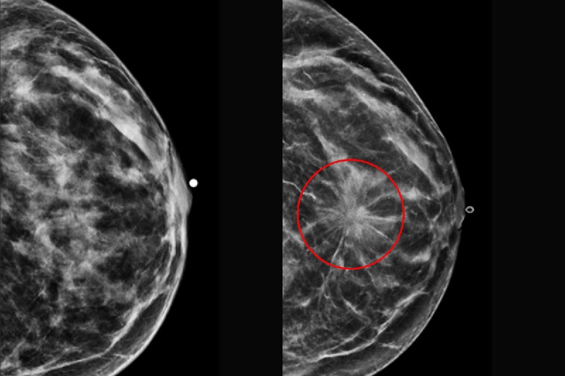 Image: The left mammogram shows dense tissue (white) but no sign of cancer. Two years later, cancer developed in the same breast (right, tumor circled in red) (Photo courtesy of Debbie Bennett/WashU Medicine)