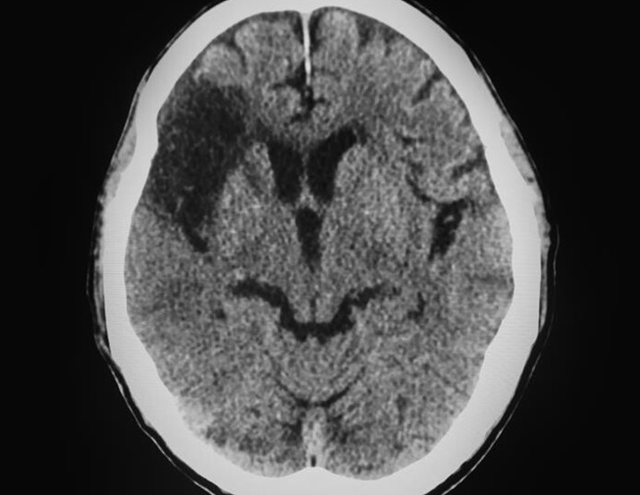 Image: The AI software pinpoints stroke timing and indicates treatment potential from a single scan (Photo courtesy of Imperial College London)