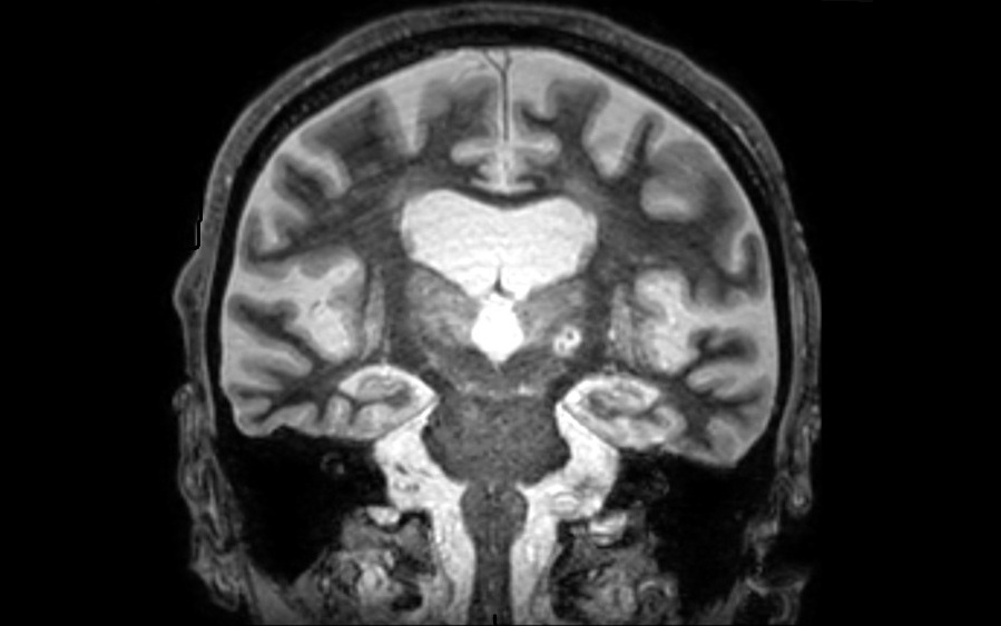 Image: A coronal MRI section shows a high-intensity focused ultrasound lesion in the left thalamus of the brain (Photo courtesy of UT Southwestern Medical Center)